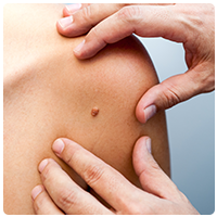 Skin Cancer Skin Cancer