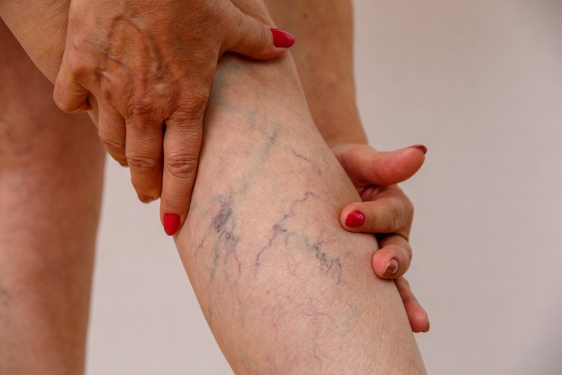 Vein Center