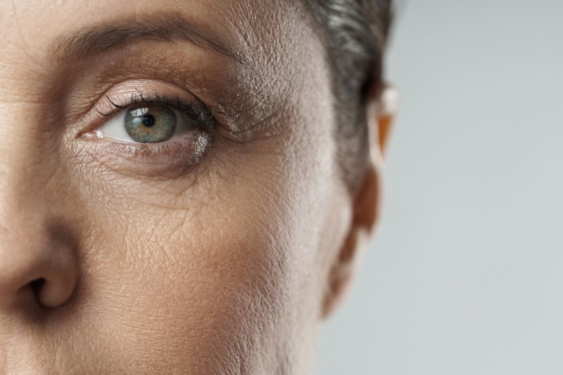 Cataracts Cataracts